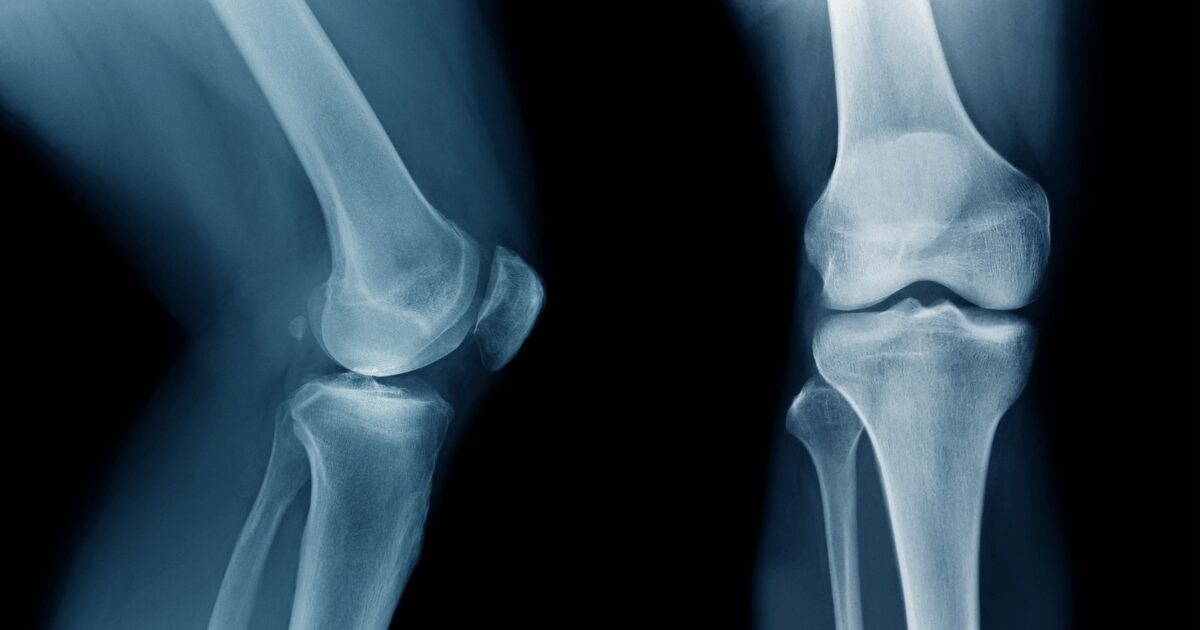 Does Menopause Cause Osteoporosis? 4 - menopause and osteoporosis knee xray for bone density